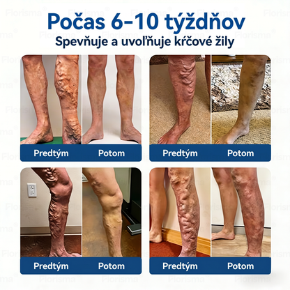 Jedna náplasť denne. Viditeľná úľava od žíl už za 7 dní🍃 𝑭𝑳𝑶𝑹𝑰𝑺𝑴𝑨® 𝐃𝐈𝐎𝐒𝐌𝐈𝐍 & 𝐇𝐄𝐒𝐏𝐄𝐑𝐈𝐃𝐈𝐍 𝐊𝐥𝐢𝐧𝐢𝐜𝐤ý-𝐒𝐭𝐮𝐩𝐞ň 𝐅𝐨𝐫𝐦𝐮𝐥𝐚 𝐬 𝐌𝐢𝐤𝐫𝐨𝐧𝐞𝐞𝐝𝐥𝐞 𝐬 𝐌𝐢𝐤𝐫𝐨𝐧𝐞𝐞𝐝𝐥𝐞 𝐍á𝐩𝐥𝐚𝐬𝐭𝐨𝐮 Pokročilá bylinná zmes cielene pôsobí na metličkové žilky a uvoľňuje ťažké a unavené nohy🎊