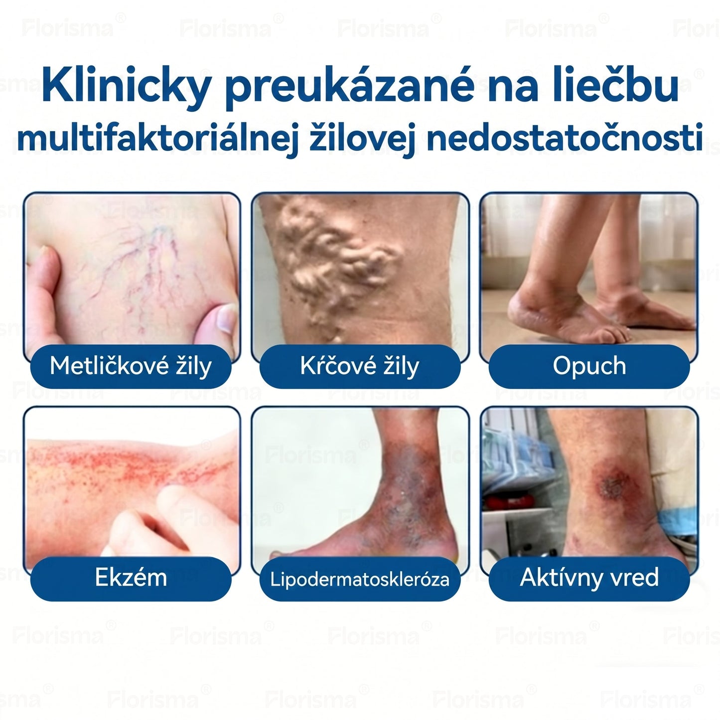 Jedna náplasť denne. Viditeľná úľava od žíl už za 7 dní🍃 𝑭𝑳𝑶𝑹𝑰𝑺𝑴𝑨® 𝐃𝐈𝐎𝐒𝐌𝐈𝐍 & 𝐇𝐄𝐒𝐏𝐄𝐑𝐈𝐃𝐈𝐍 𝐊𝐥𝐢𝐧𝐢𝐜𝐤ý-𝐒𝐭𝐮𝐩𝐞ň 𝐅𝐨𝐫𝐦𝐮𝐥𝐚 𝐬 𝐌𝐢𝐤𝐫𝐨𝐧𝐞𝐞𝐝𝐥𝐞 𝐬 𝐌𝐢𝐤𝐫𝐨𝐧𝐞𝐞𝐝𝐥𝐞 𝐍á𝐩𝐥𝐚𝐬𝐭𝐨𝐮 Pokročilá bylinná zmes cielene pôsobí na metličkové žilky a uvoľňuje ťažké a unavené nohy🎊