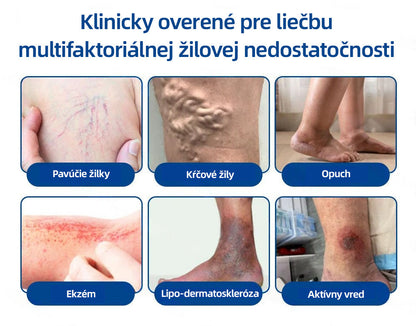 Healrize® VeinTarget mikrojihlová náplasť 🚀 Okamžitá úľava, dlhodobé výsledky 🚀