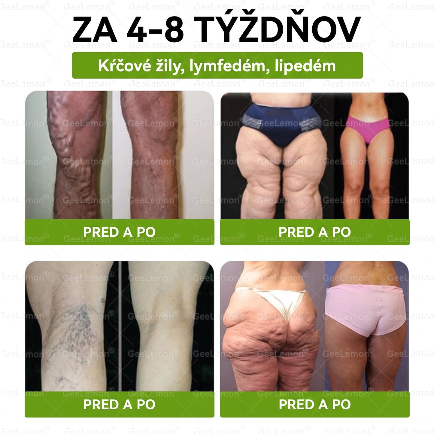 Oficiálne certifikované 🔥 Tisíce spokojných používateľov na Slovensku💗🥰𝐆𝐞𝑒𝐿𝑒𝐦𝐨𝐧® 𝐆𝐥𝐮𝐦𝐚𝐬𝐞𝐭𝐢𝐝𝐞  8 IN 1" TENKY A ZDRAVY MIKROIHLICKOVY PLASTER ((Iba raz denne, viditeľné zmeny do 7 dní))  ✅