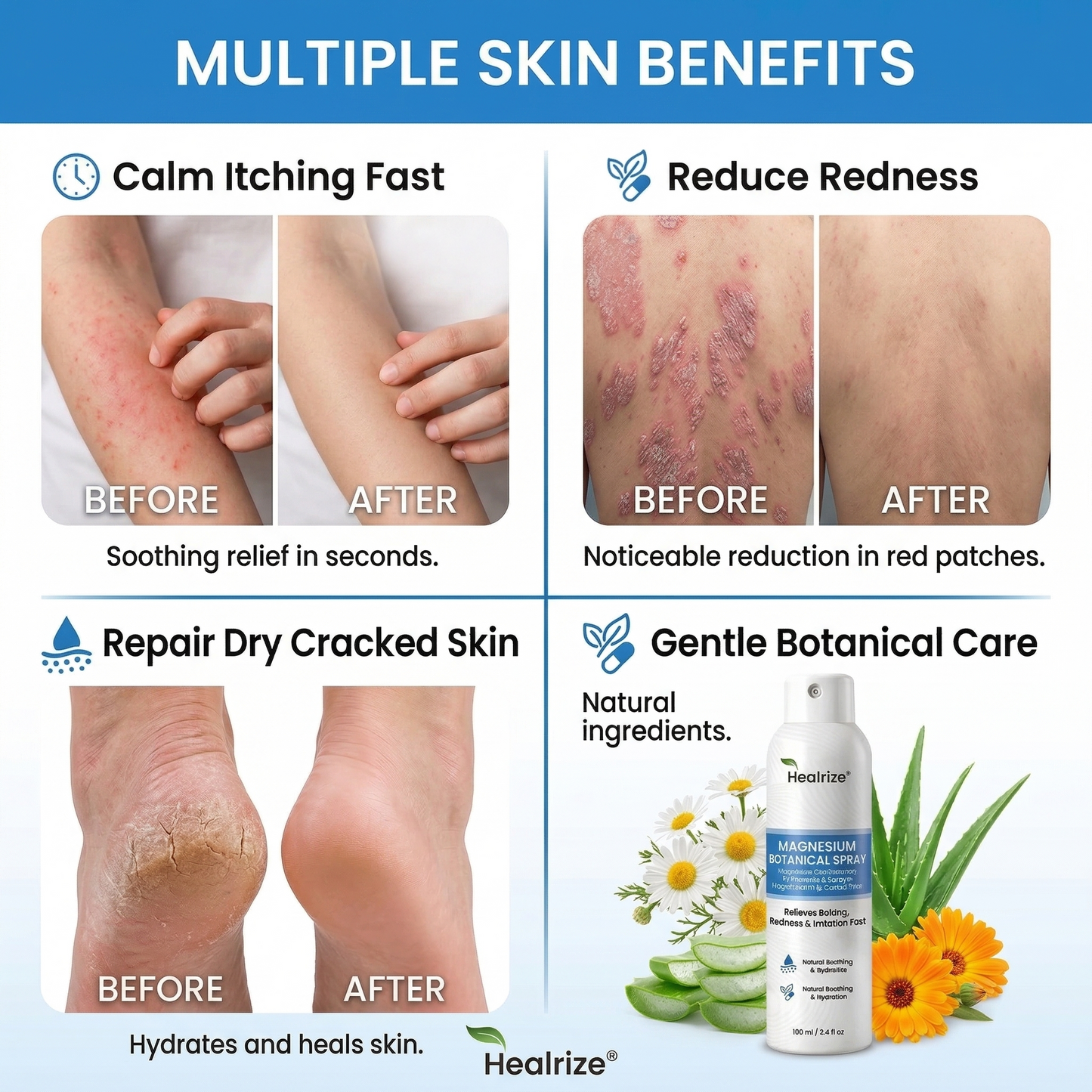 Healrize® Magnesium Botanical Spray🔥 – Advanced Skin Recovery for Psoriasis & Eczema | Rapid Soothing, Steroid-Free