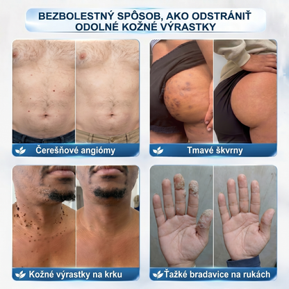𝐏i𝐜𝐝o® 𝟕-𝐝ñ𝐨𝐯𝐲 𝐨𝐝𝐬𝐭𝐫𝐚ñ𝐨𝐯𝐚č 𝐤𝐨ž𝐧ý𝐜𝐡 𝐯ý𝐫𝐚𝐬𝐭𝐤𝐨𝐯 𝐚 š𝐤𝐯𝐫𝐧(Žiadna bolesť, nula rollerballov)💪