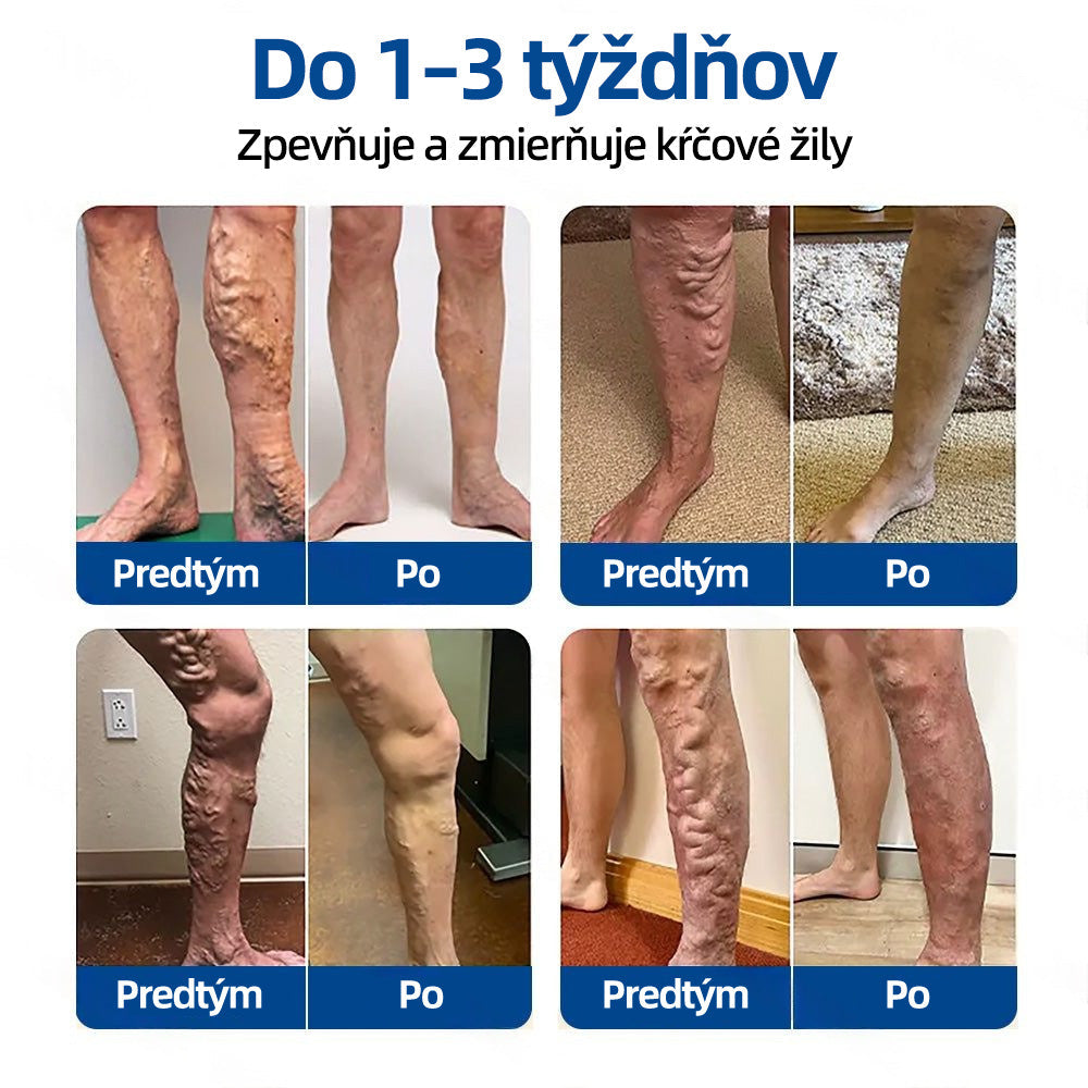 Healrize® VeinTarget mikrojihlová náplasť 🚀 Okamžitá úľava, dlhodobé výsledky 🚀