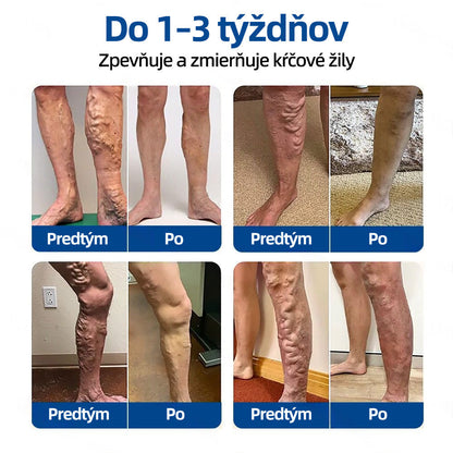 Healrize® VeinTarget mikrojihlová náplasť 🚀 Okamžitá úľava, dlhodobé výsledky 🚀