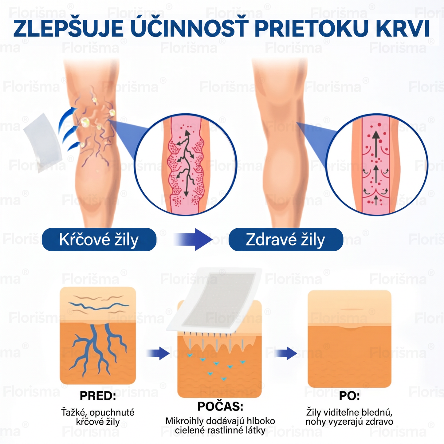 Jedna náplasť denne. Viditeľná úľava od žíl už za 7 dní🍃 𝑭𝑳𝑶𝑹𝑰𝑺𝑴𝑨® 𝐃𝐈𝐎𝐒𝐌𝐈𝐍 & 𝐇𝐄𝐒𝐏𝐄𝐑𝐈𝐃𝐈𝐍 𝐊𝐥𝐢𝐧𝐢𝐜𝐤ý-𝐒𝐭𝐮𝐩𝐞ň 𝐅𝐨𝐫𝐦𝐮𝐥𝐚 𝐬 𝐌𝐢𝐤𝐫𝐨𝐧𝐞𝐞𝐝𝐥𝐞 𝐬 𝐌𝐢𝐤𝐫𝐨𝐧𝐞𝐞𝐝𝐥𝐞 𝐍á𝐩𝐥𝐚𝐬𝐭𝐨𝐮 Pokročilá bylinná zmes cielene pôsobí na metličkové žilky a uvoľňuje ťažké a unavené nohy🎊