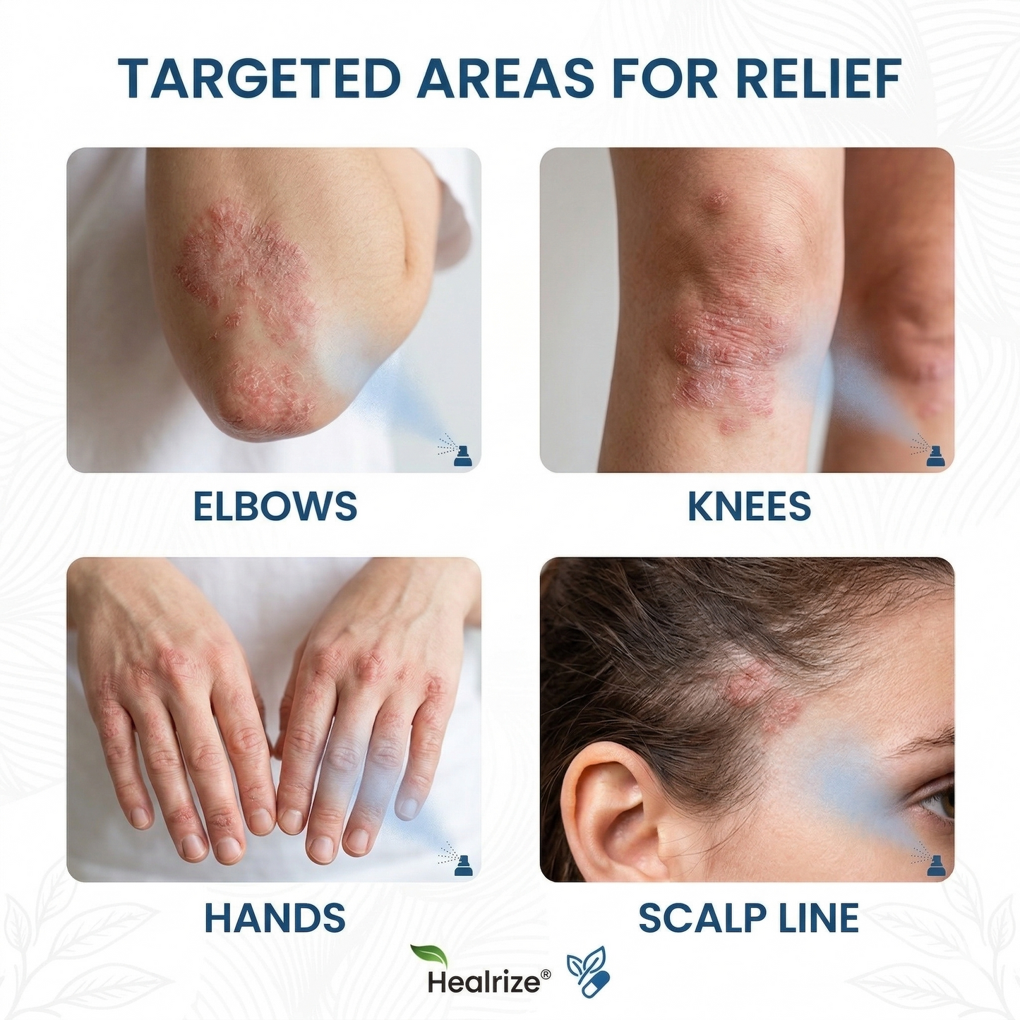 Healrize® Magnesium Botanical Spray🔥 – Advanced Skin Recovery for Psoriasis & Eczema | Rapid Soothing, Steroid-Free