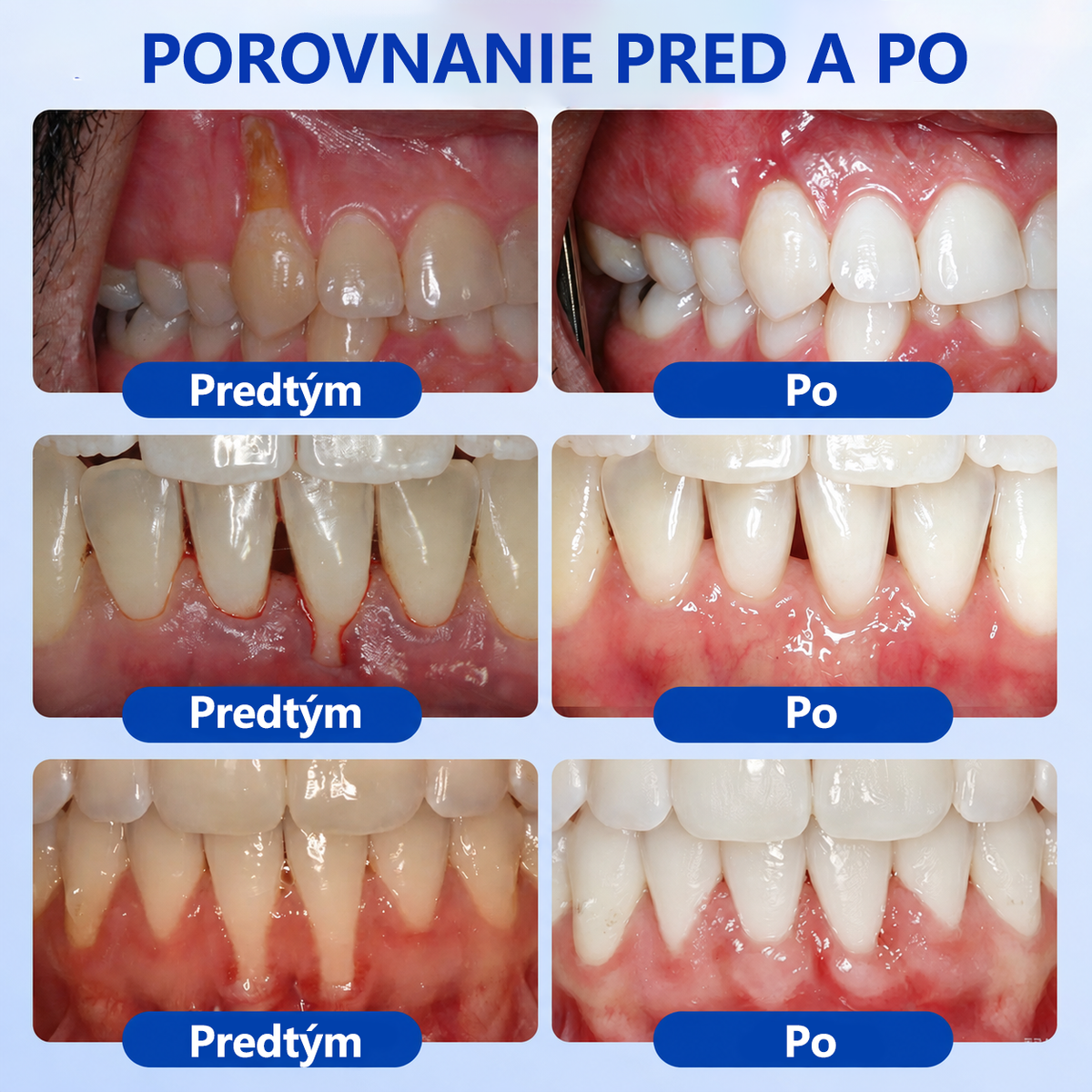 👩‍⚕️ 𝑮𝒍𝒊𝒎𝒎𝒆𝒓𝒍𝒚® 🦷 𝑮𝒖𝒎𝑹𝒆𝒗𝒊𝒗𝒆 – gél na obnovu parodontu 🎧