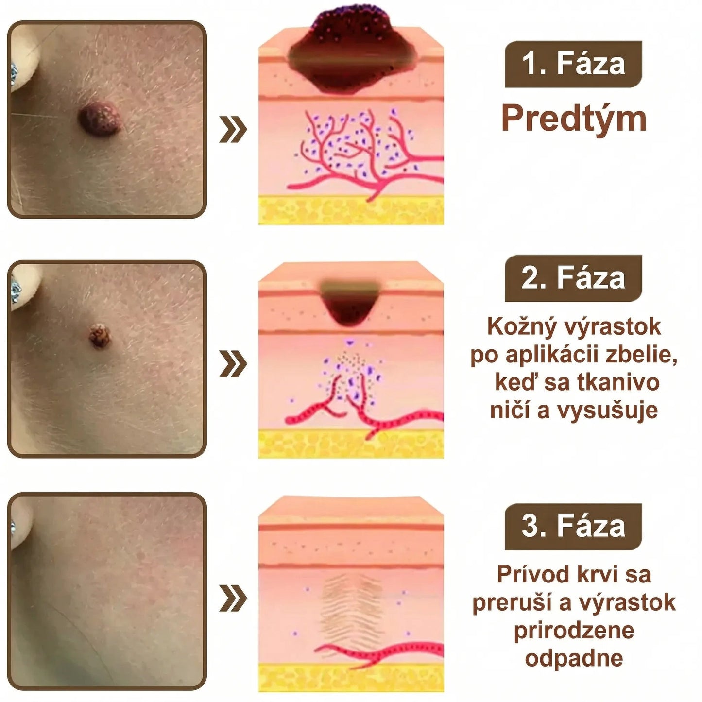 FIVFIVGO® Upokojujúci regeneračný krém s čiernou a bielou ryžou👨‍⚕️ Schválené ŠÚKL(Odstraňovanie bradavíc a kožných výrastkov, senilnej purpury, čerešňových angiómov, rakoviny kože a seboroickej keratózy).)⏰