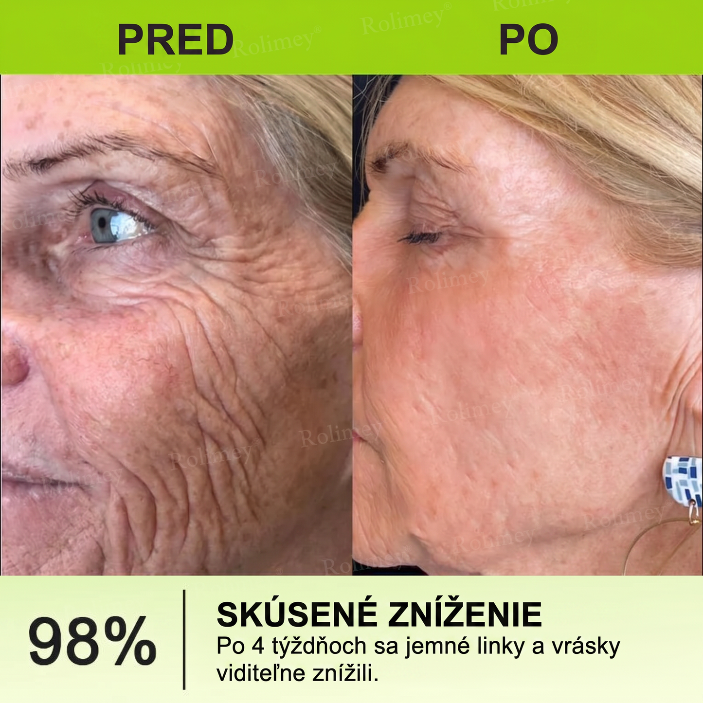 🌸Rolimey®  Botox & Vita-A Retinol Retinol Shot Krém proti vraskam a na spevnenie pleti ⏰Posledný deň! 70% zľava💡